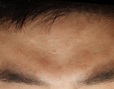 이마 편평사마귀 치료 후
